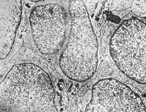 M,7y. | medulloblastoma